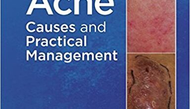 free-pdf-download-Acne: Causes and Practical Management 1st Edition