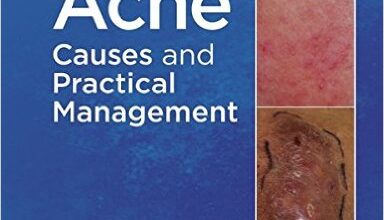 free-pdf-download-Acne: Causes and Practical Management