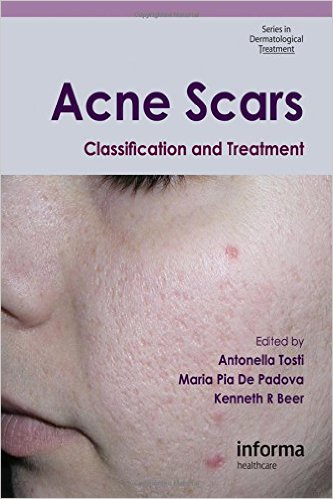 free-pdf-download-Acne Scars: Classification and Treatment (Series in Dermatological Treatment) 1st Edition