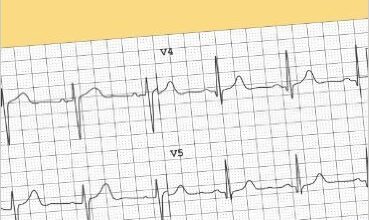 free-pdf-download-Atlas of Electrocardiography 1st Edition