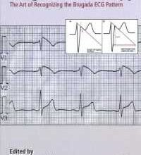 free-pdf-download-Brugada Phenocopy: The Art of Recognizing the Brugada ECG Pattern 1st Edition