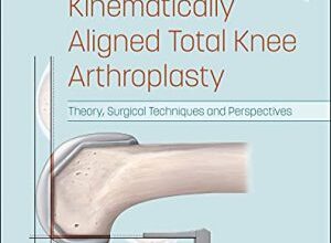 free-pdf-download-Calipered Kinematically aligned Total Knee Arthroplasty