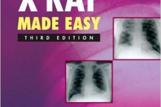 free-pdf-download-Chest X-Ray Made Easy