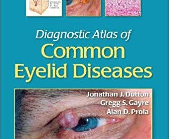 free-pdf-download-Diagnostic Atlas of Common Eyelid Diseases 1st Edition