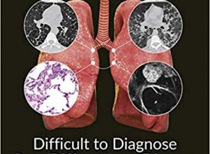 free-pdf-download-Difficult to Diagnose Rare Diffuse Lung Disease