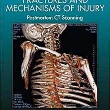 free-pdf-download-Forensic Pathology of Fractures and Mechanisms of Injury: Postmortem CT Scanning 1st Edition