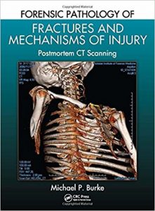 free-pdf-download-Forensic Pathology of Fractures and Mechanisms of Injury: Postmortem CT Scanning 1st Edition