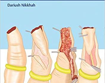 free-pdf-download-Hand Trauma: Illustrated Surgical Guide of Core Procedures Illustrated Edition