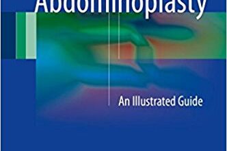 free-pdf-download-Inverse Abdominoplasty: An Illustrated Guide 1st ed. 2017 Edition