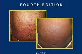 free-pdf-download-Moderate to Severe Psoriasis