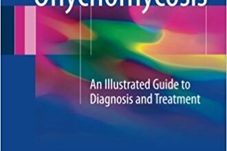 free-pdf-download-Onychomycosis: An Illustrated Guide to Diagnosis and Treatment 1st ed. 2017 Edition