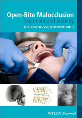 free-pdf-download-Open-Bite Malocclusion: Treatment and Stability 1st Edition