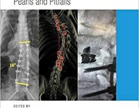 free-pdf-download-Revision Spine Surgery: Pearls and Pitfalls