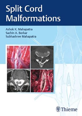 free-pdf-download-Split Cord Malformations