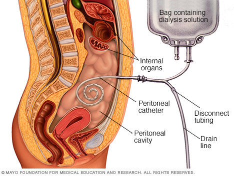 free-pdf-download-Surgical Aspects of Peritoneal Dialysis 1st ed. 2017 Edition