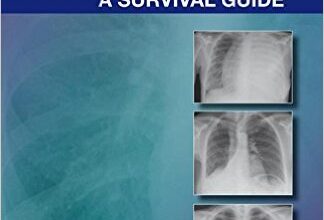 free-pdf-download-The Chest X-Ray: A Survival Guide